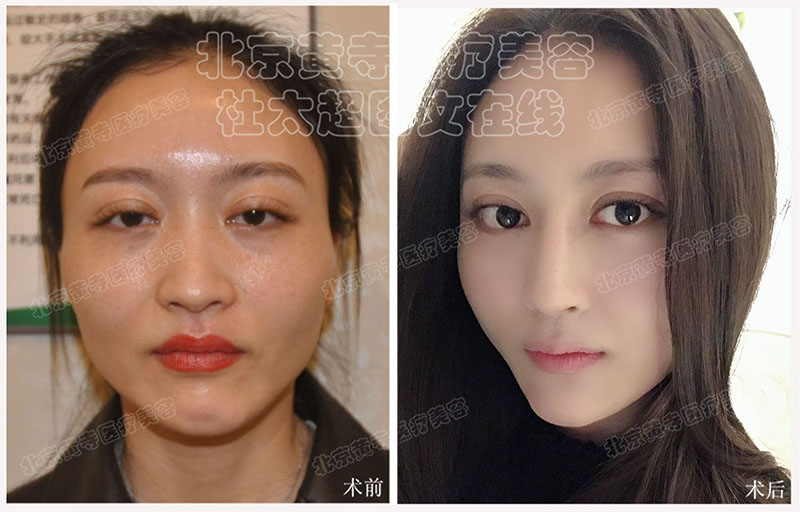 面部脂肪填充术后1个月