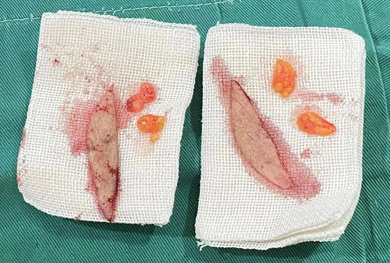 上睑松弛改善，是不是祛除的皮肤越多越好？