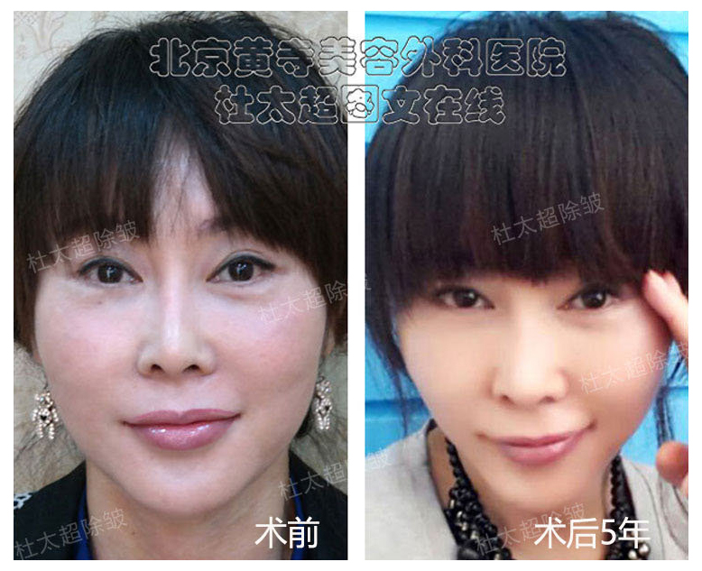 拉皮手术好吗？