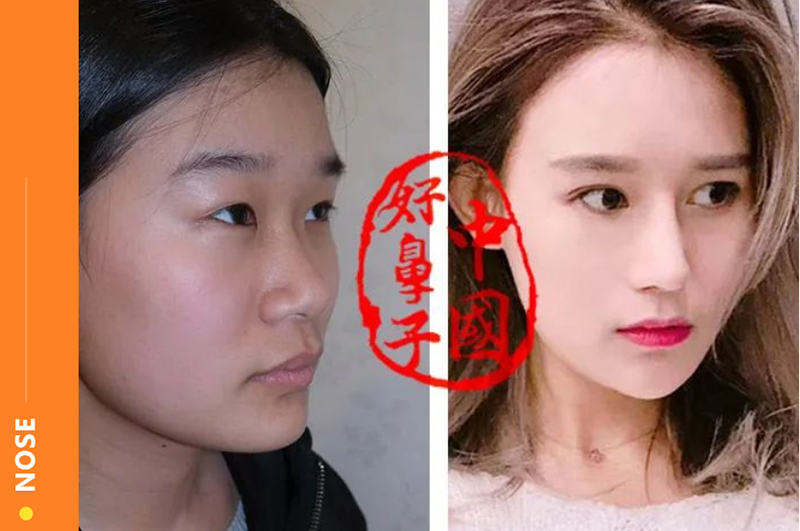 鼻整形看起来很假的原因！