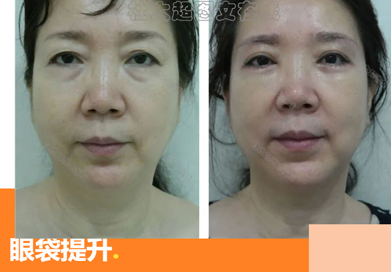 眼袋的手术能提升“苹果”肌吗？