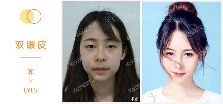 双眼皮手术为什么会受欢迎？
