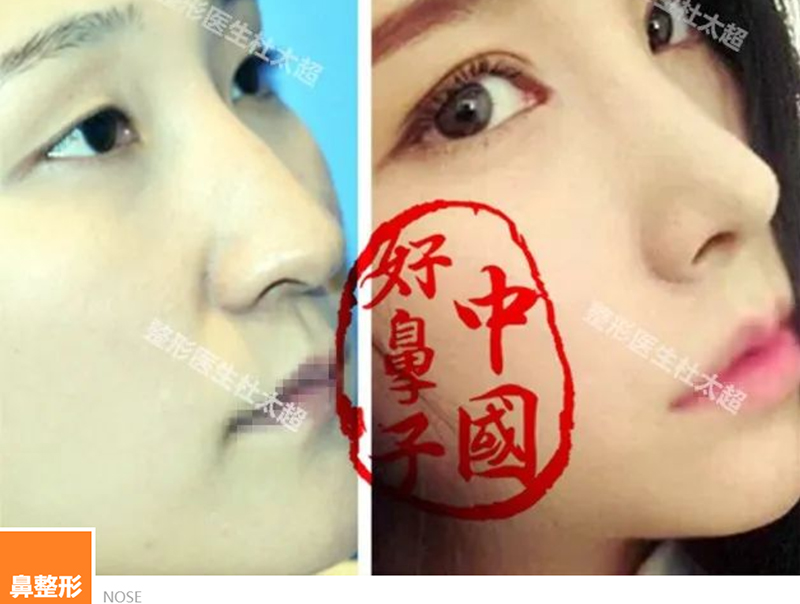 什么是成功的鼻部整形手术