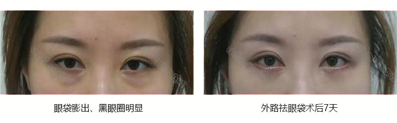年轻人祛眼袋的案例