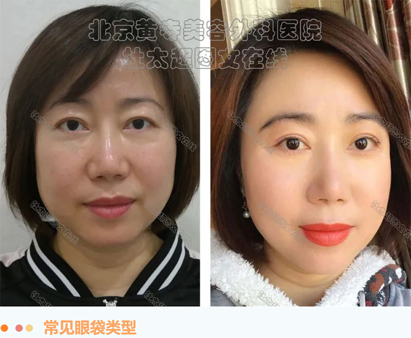 眼袋=老态，改善眼袋从这里做起