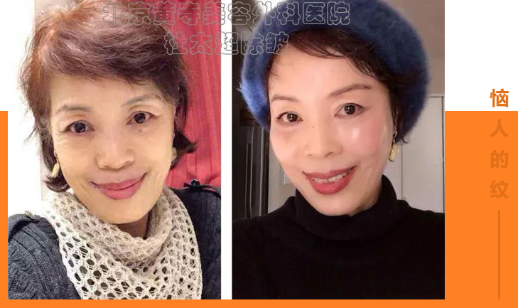 目前常见的除皱治疗方法有哪些?