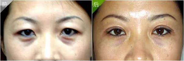 提眉和双眼皮可以一起做吗?