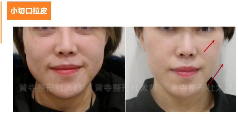 小切口拉皮真的管用吗？