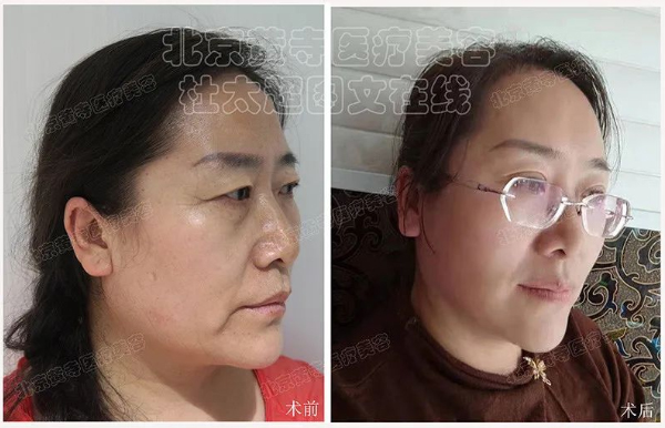 眼周鱼尾纹怎么才能消除？