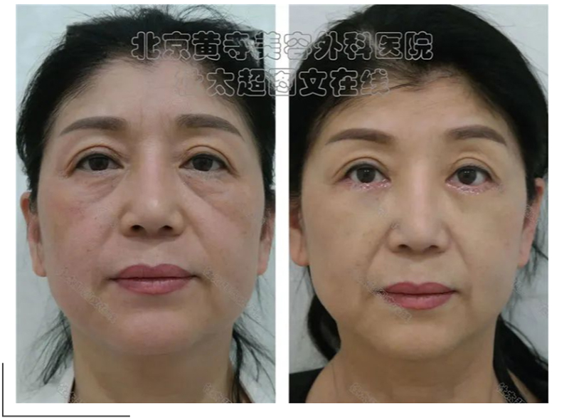 不同类型的眼袋切除后会重新长出吗？