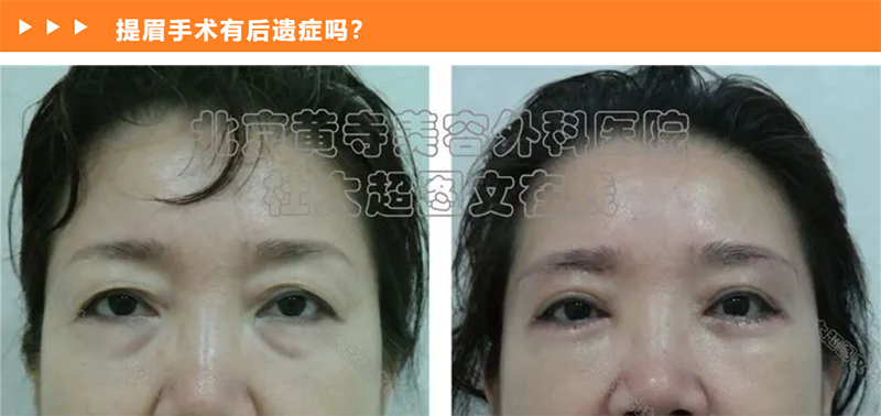 提眉手术后会有后遗症吗？