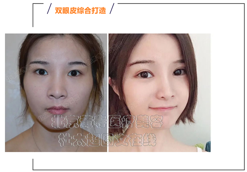 双眼皮的几种类型及适合人群