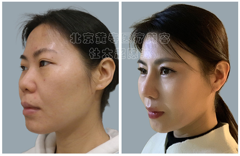 面部抗衰是先做加法还是先做减法？