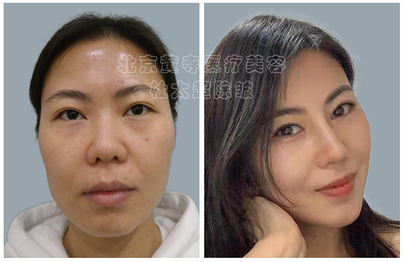 面部抗衰是先做加法还是先做减法？