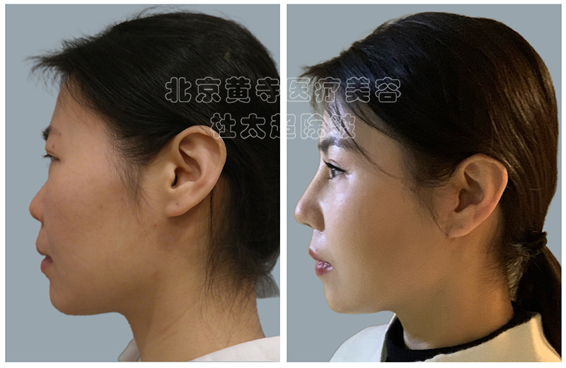 面部抗衰是先做加法还是先做减法？