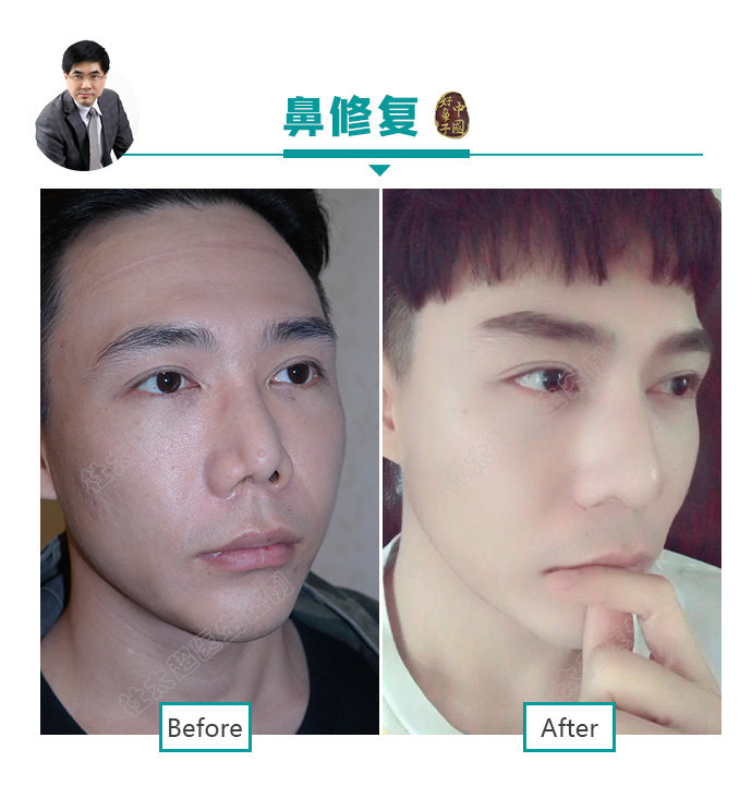 隆鼻、鼻整形并不是女性求美者的专利! 隆鼻、鼻整形并不是女性求美者的专利!