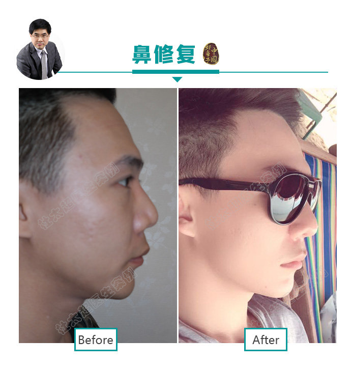 隆鼻、鼻整形并不是女性求美者的专利! 隆鼻、鼻整形并不是女性求美者的专利!