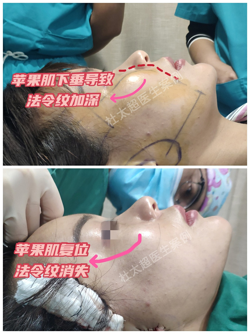 黄寺杜太超小切口拉皮技术到底好在哪里？