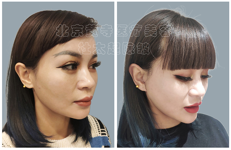 黄寺杜太超小切口拉皮技术到底好在哪里？