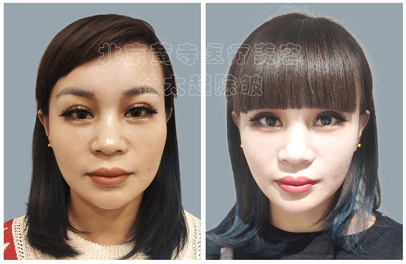 黄寺杜太超小切口拉皮技术到底好在哪里？