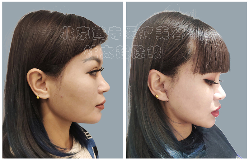 黄寺杜太超小切口拉皮技术到底好在哪里？