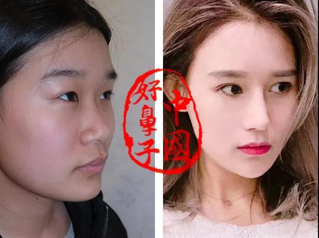 想要做美鼻的话，怎么样鼻型是适合自己？