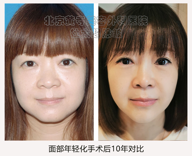 拉皮手术的时效性您有了解过吗？