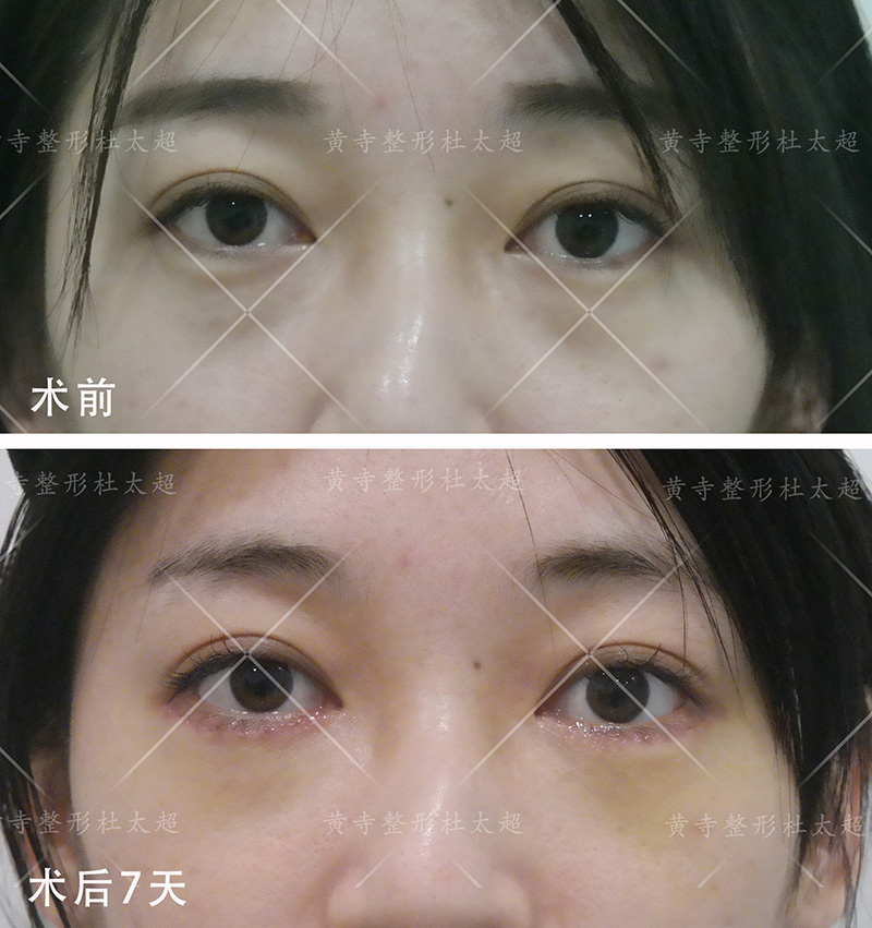 眼袋手术常见的误区您了解过吗？