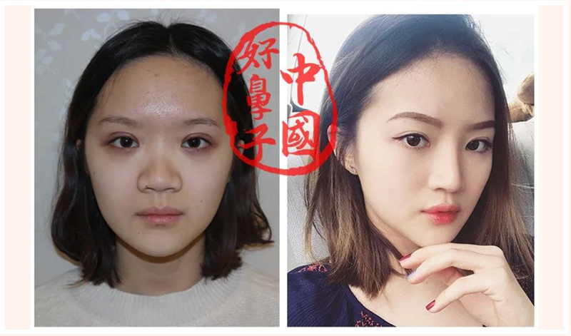 一个鼻子毁一张脸该怎么拯救？