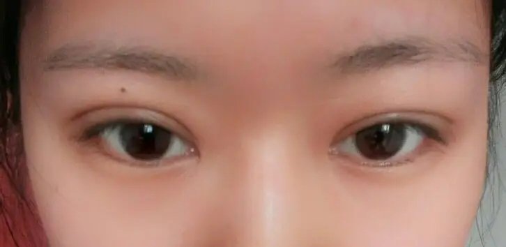 双眼皮刚拆线不对称怎么办？