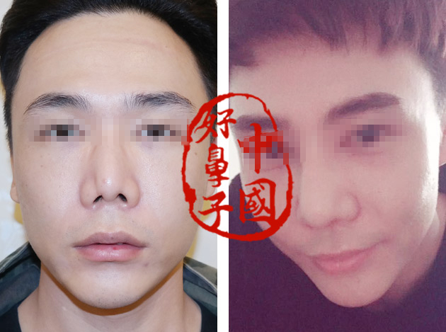 假体到了一定的时间需要更换吗？