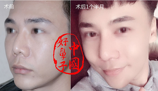 假体到了一定的时间需要更换吗？