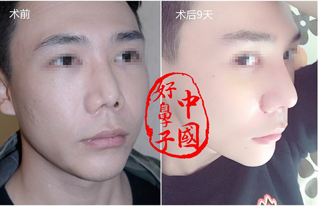 假体到了一定的时间需要更换吗？