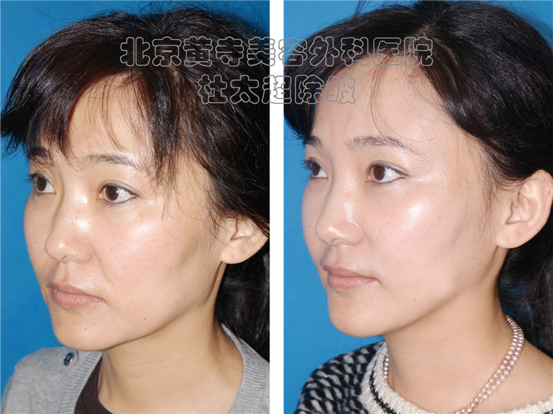 小切口拉的不够紧怎么办？