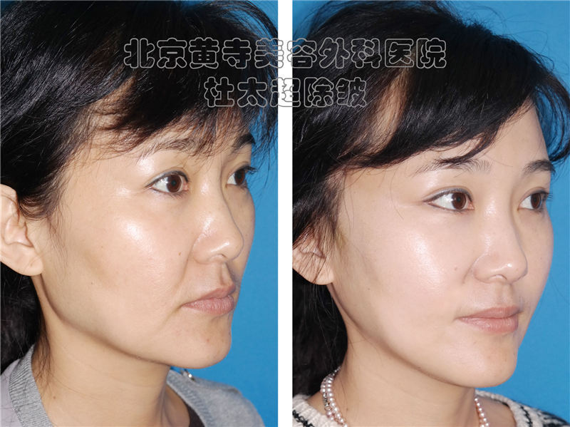 小切口拉的不够紧怎么办？