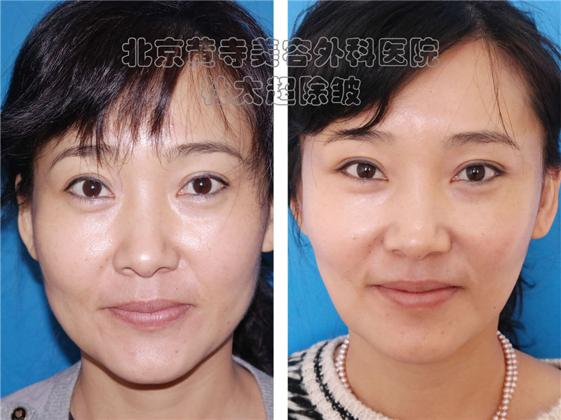 小切口拉的不够紧怎么办？