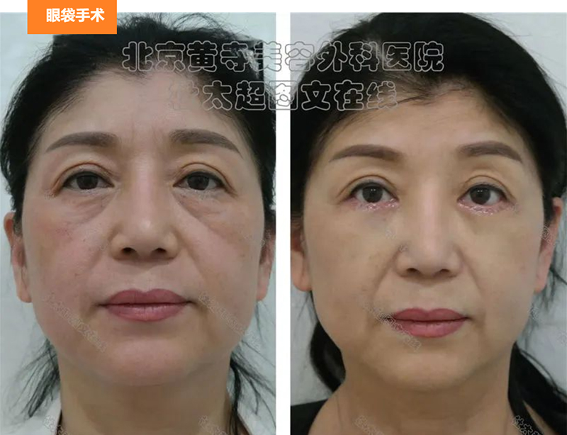 眼袋手术切勿贪小便宜！