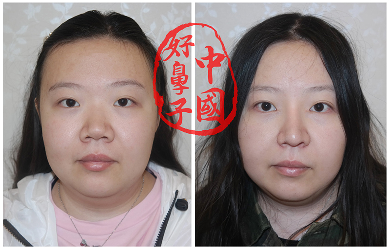 鼻整形的那些事该如何避免？