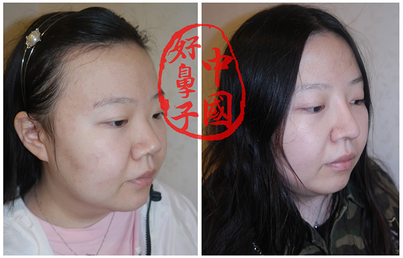 鼻整形的那些事该如何避免？