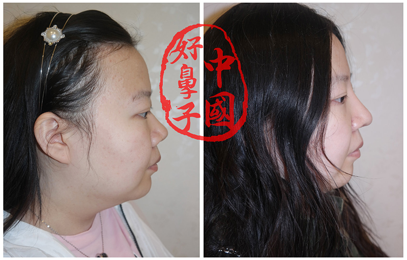 鼻整形的那些事该如何避免？