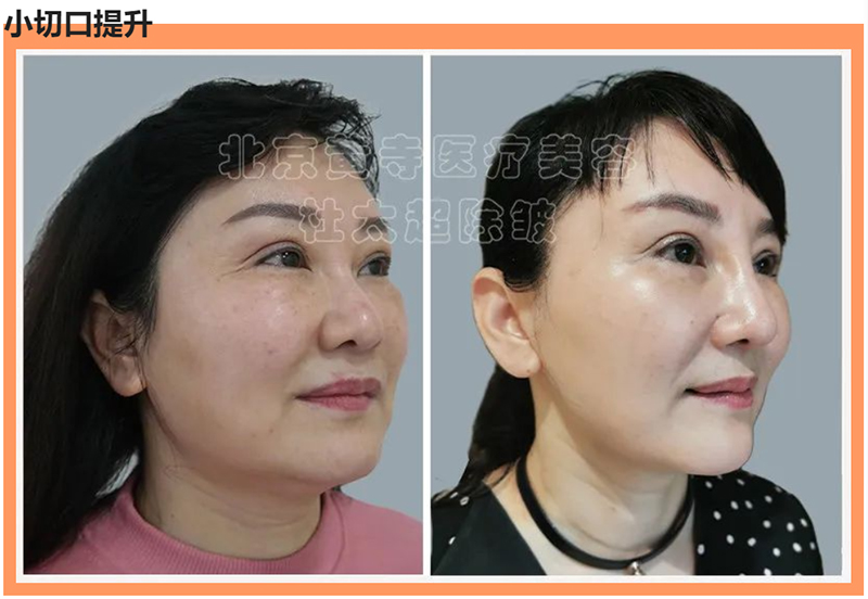 拉皮手术的这些误区您了解过吗？