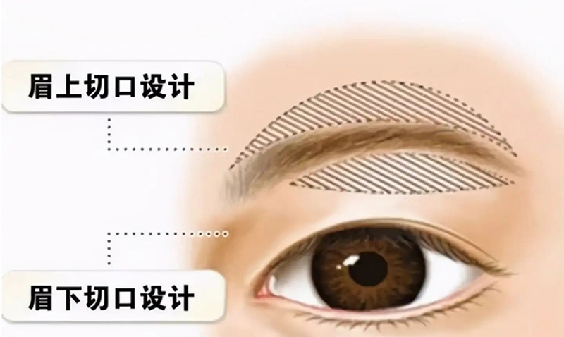 眼部年轻化提眉的那些事儿