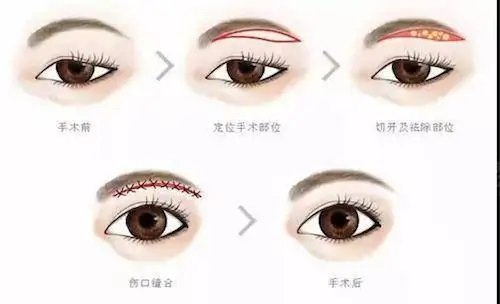 眼部年轻化提眉的那些事儿