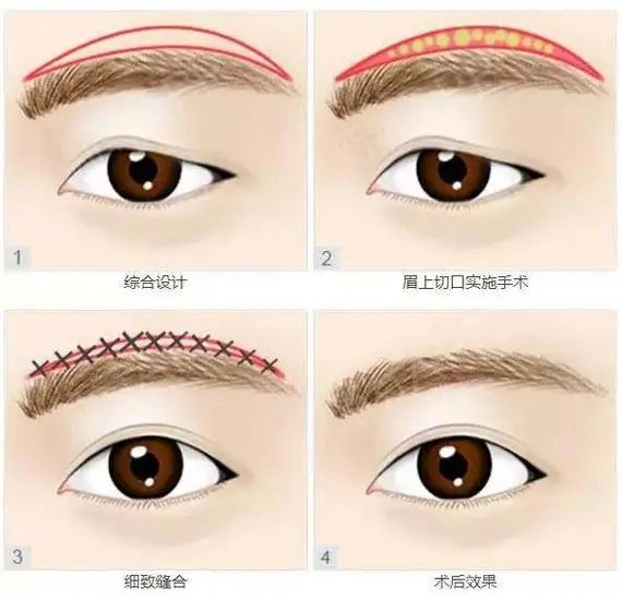 眼部年轻化提眉的那些事儿