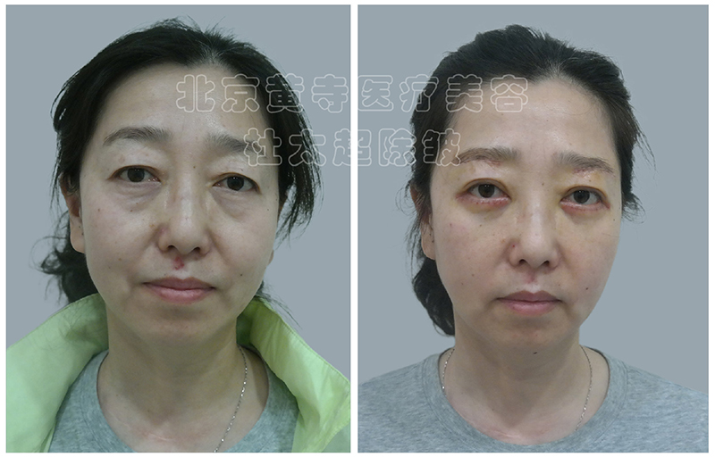 眼部年轻化提眉的那些事儿