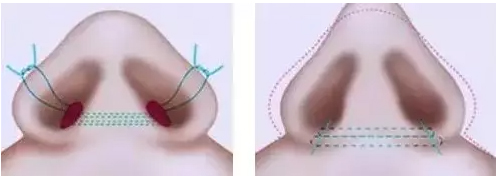 为什么鼻整形医生会强烈要求你面诊？
