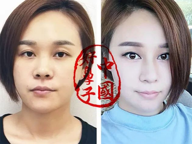 鼻整形要好看,必须考虑五官协调! 鼻整形要好看,必须考虑五官协调!