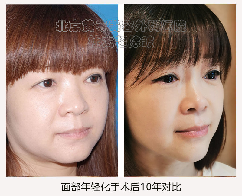 拉皮与其他除皱方式相比有什么不同？