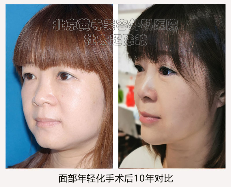 拉皮与其他除皱方式相比有什么不同？