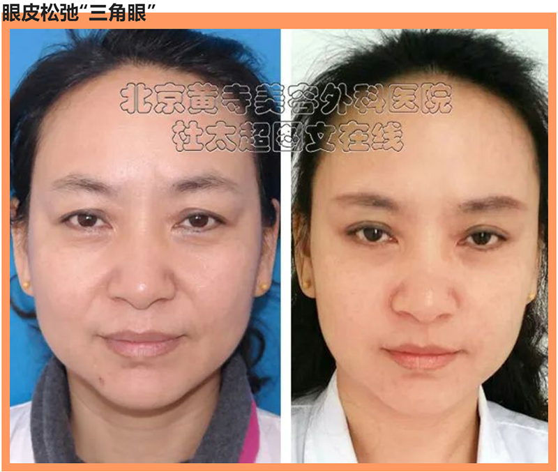 松弛的三角眼让很多人都扼腕叹息 松弛的三角眼让很多人都扼腕叹息